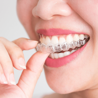 Achieve a confident smile with invisalign treatment in charlotte, nc 3 Woman putting on invisalign aligners, representing invisalign treatment in charlotte